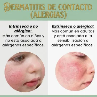 DERMATITIS ALERGICA