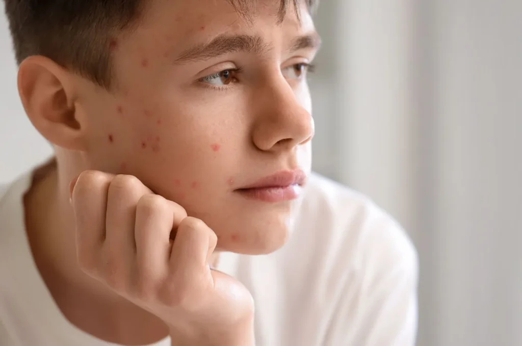 acne