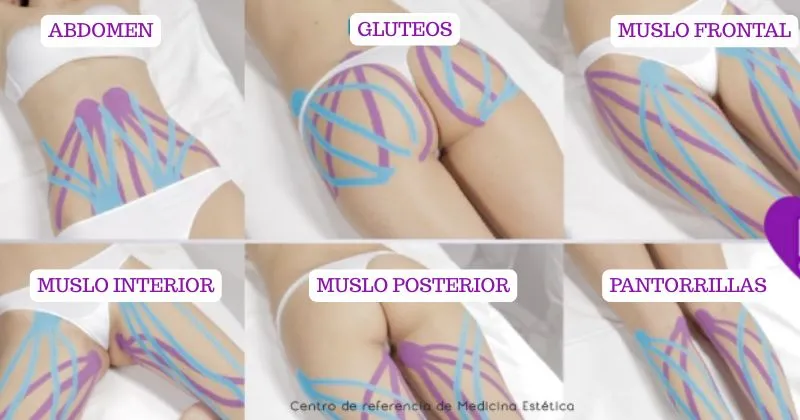 Kinesiotape Estético
