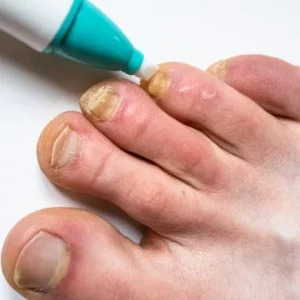 onicomicosis