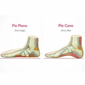 pie plano y pie cavo