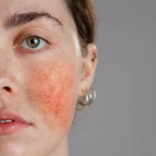 rosacea