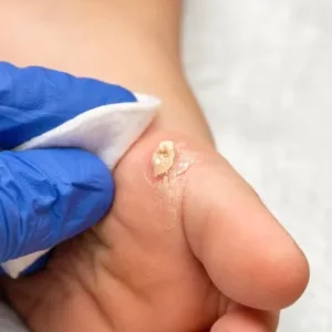 verruga plantar